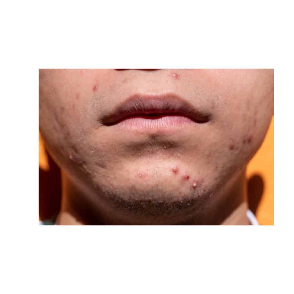 acne in puberty