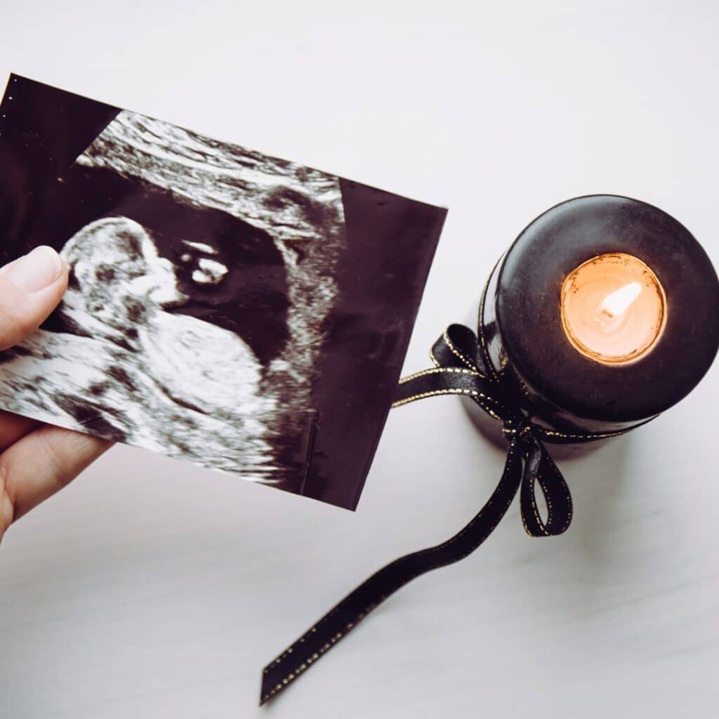 Pregnancy and infant loss, baby scan